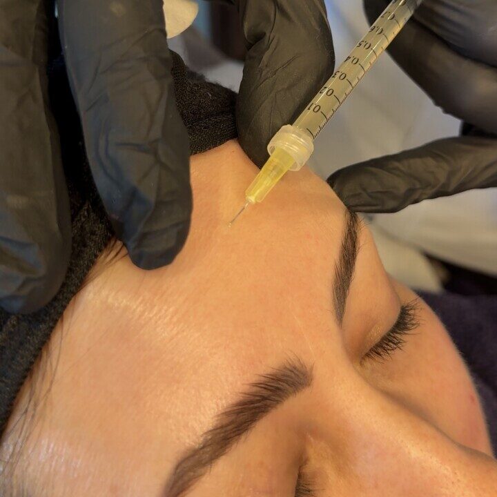 PRP Facial