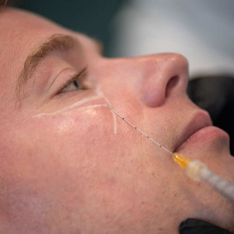 Tear Trough Filler