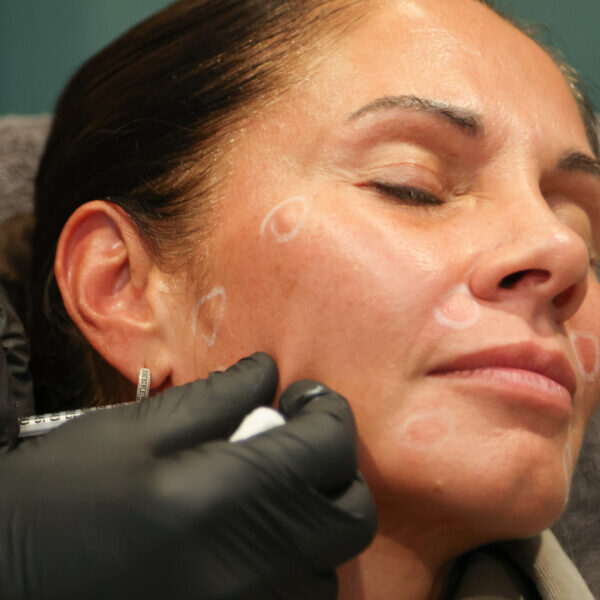 Cheek Filler