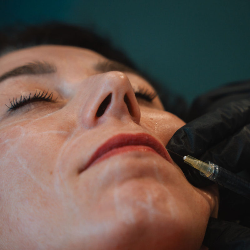 Lip Filler