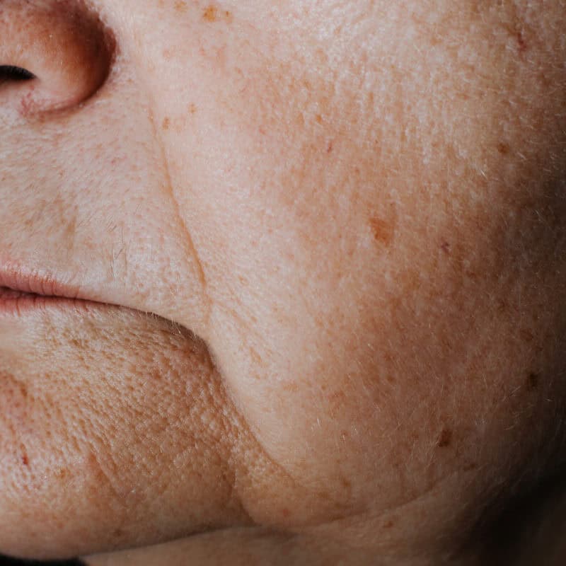 Endolift