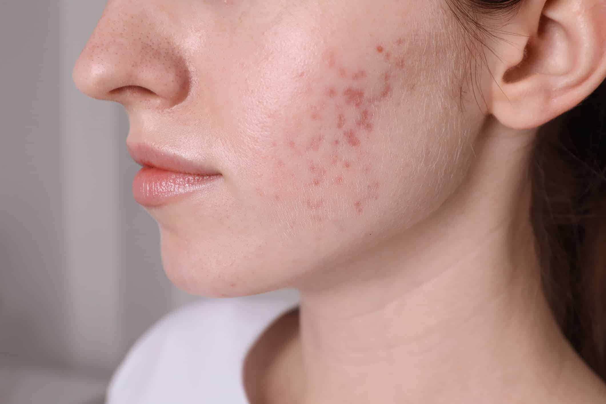 Red or Brown Marks, Not Scars