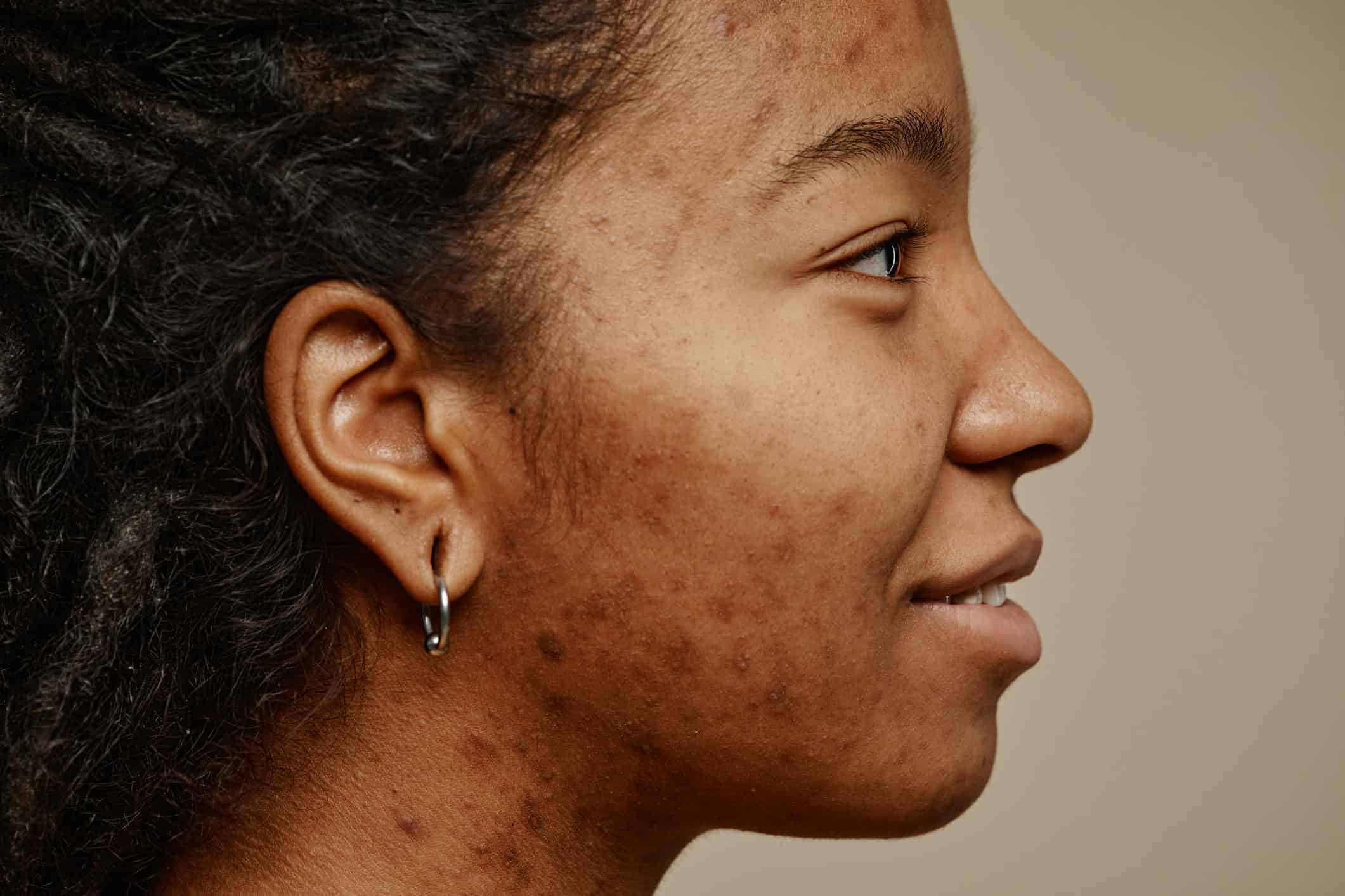Scarring on Deeper Skin Tones