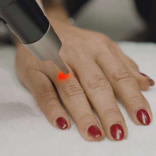 Laser treatment on the backs of the hands