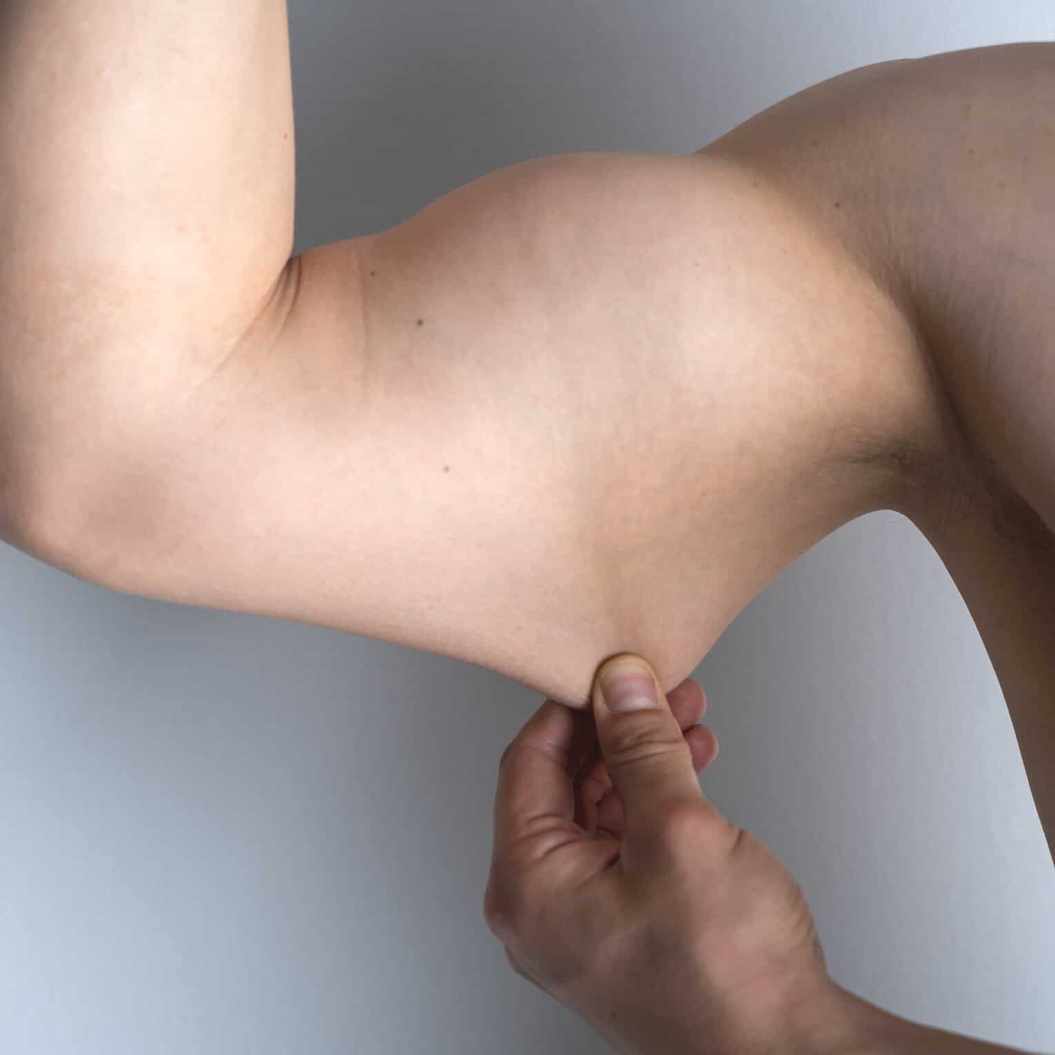 Arms After Weight Loss