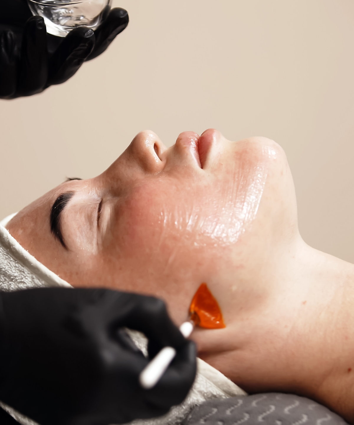 Chemical peels