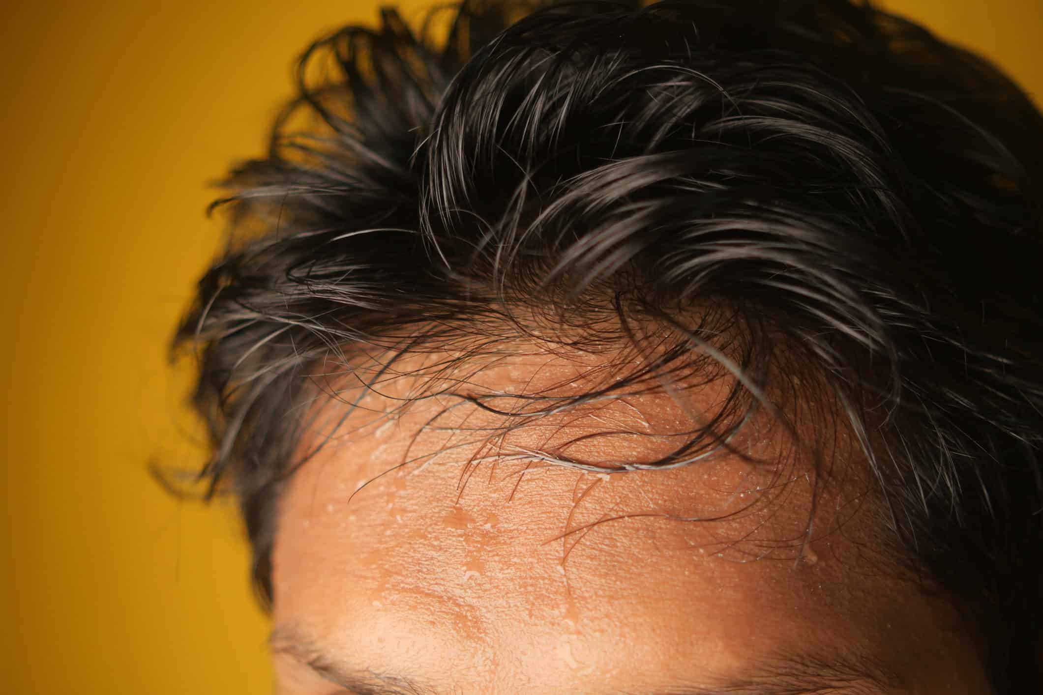 A Forehead That Beads Up