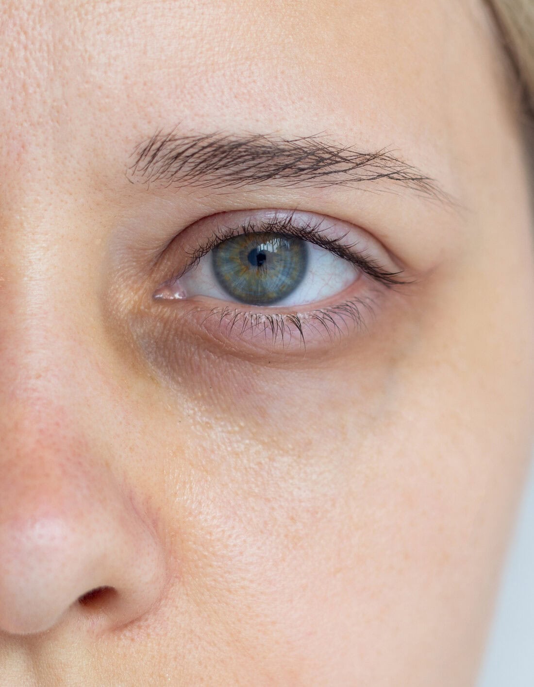 Close up of a hollow groove beneath the lower eyelid