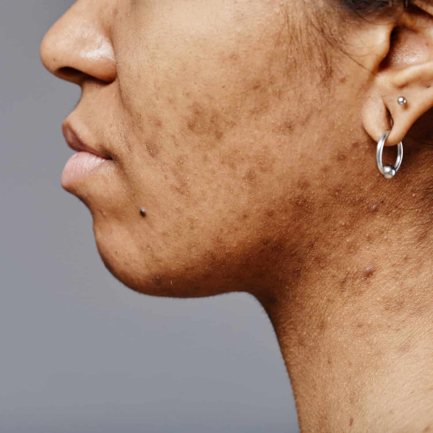 Texture Where Acne Used to Be