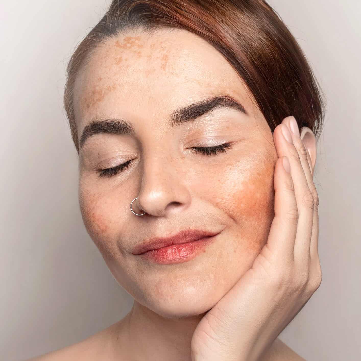 Hormonal and Pregnancy Pigmentation