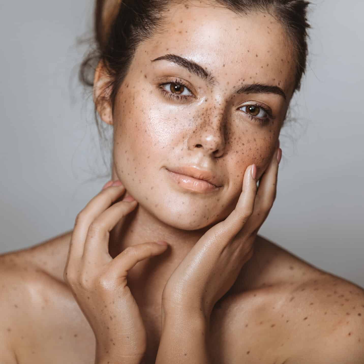 Freckles and Lentigines