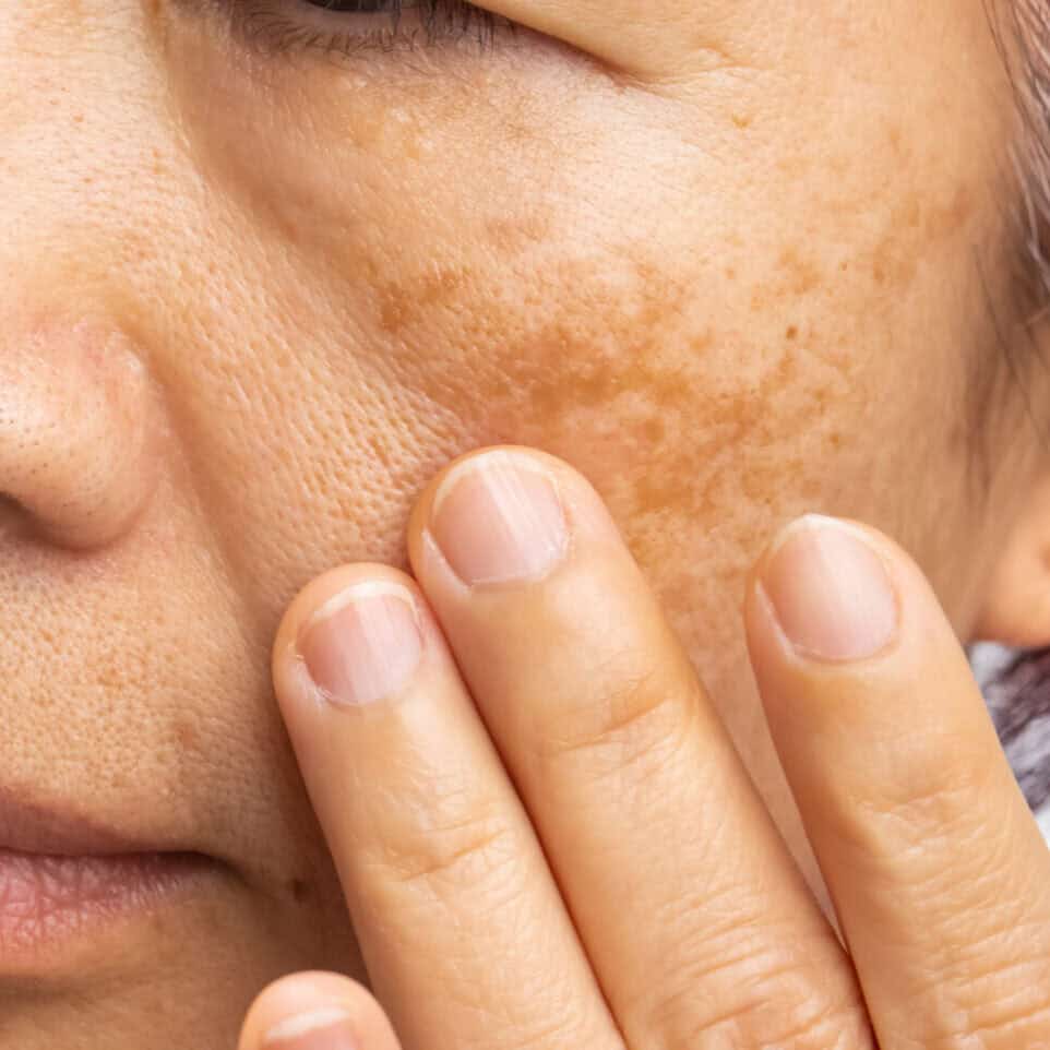 Melasma