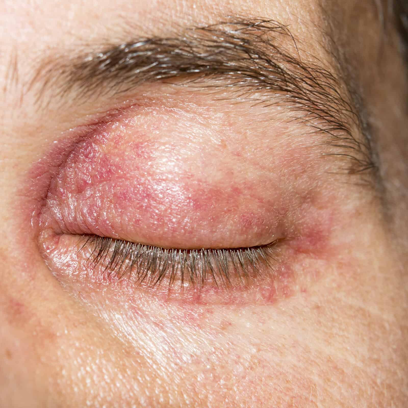 Sore Eyes or a Thickening Nose
