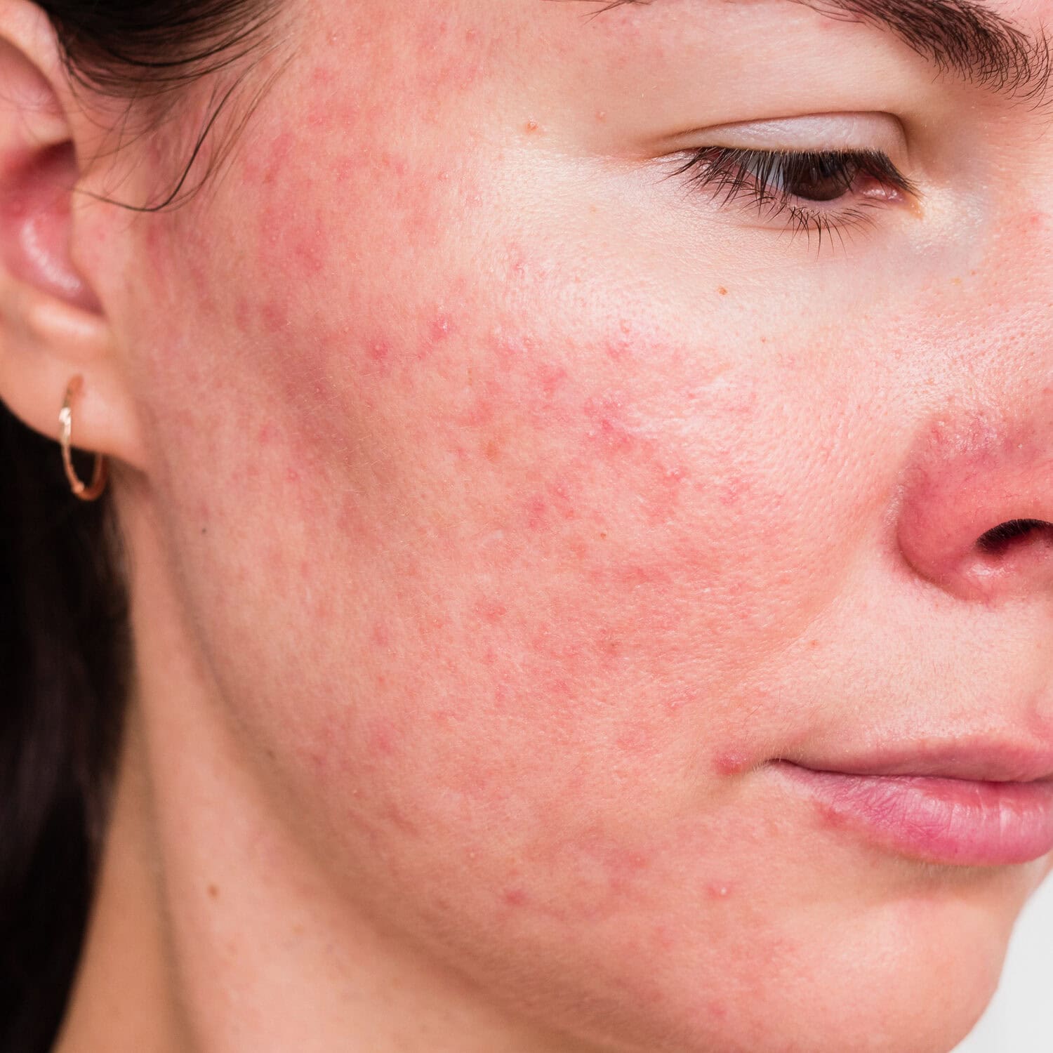 Bumps That Arrive With the Redness