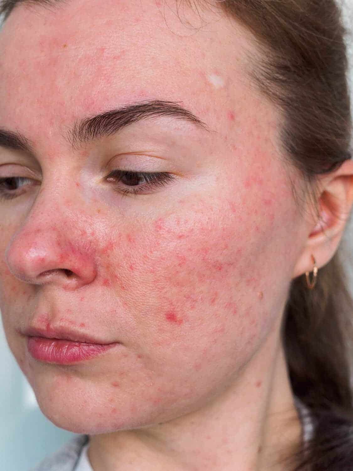 Fine Red Veins Around the Nose
