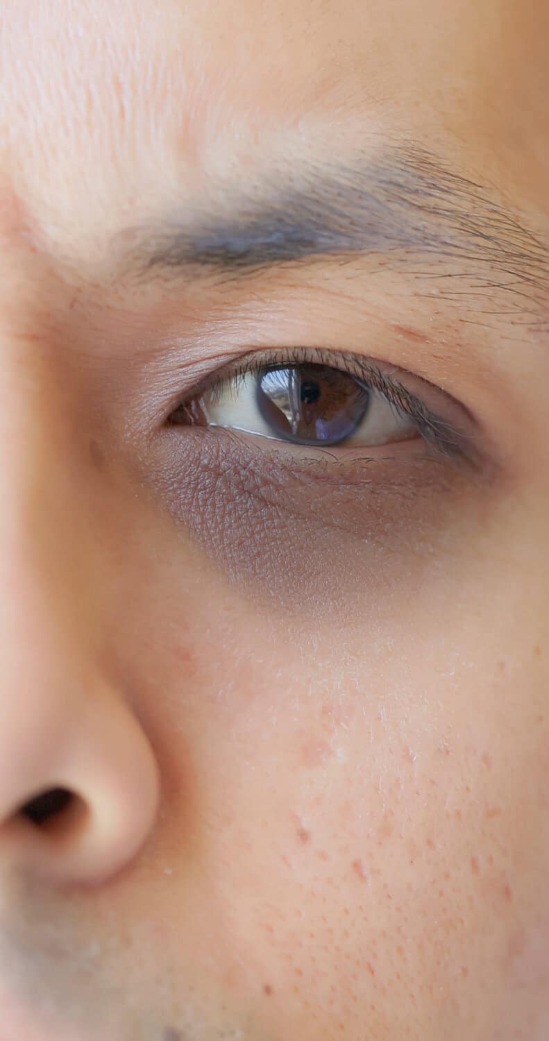 Close up of thin under-eye skin showing a bluish shadow