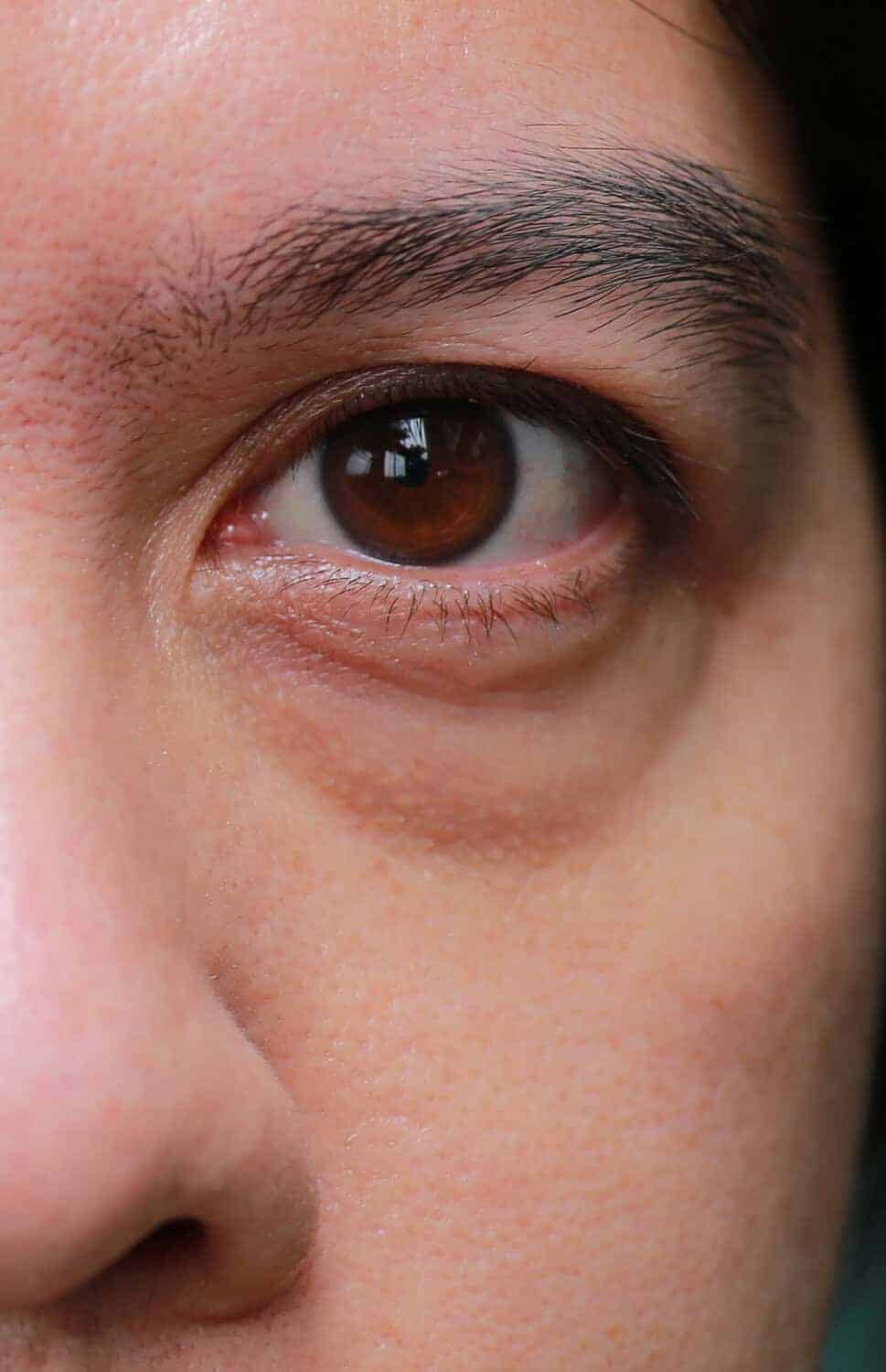 Close up of puffiness and swelling beneath the lower eyelid
