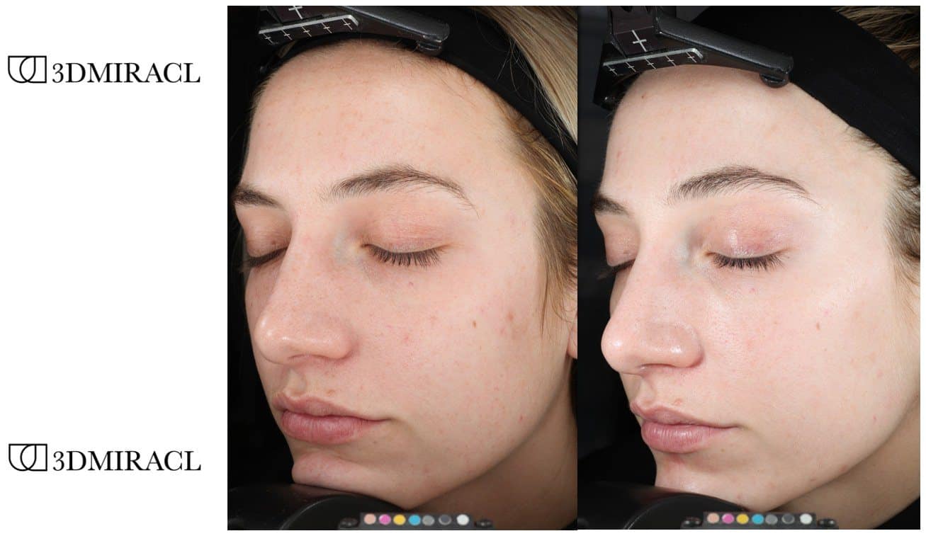 Before and after 3DMIRACL UltraClear treatment on a young woman, skin brighter and more even