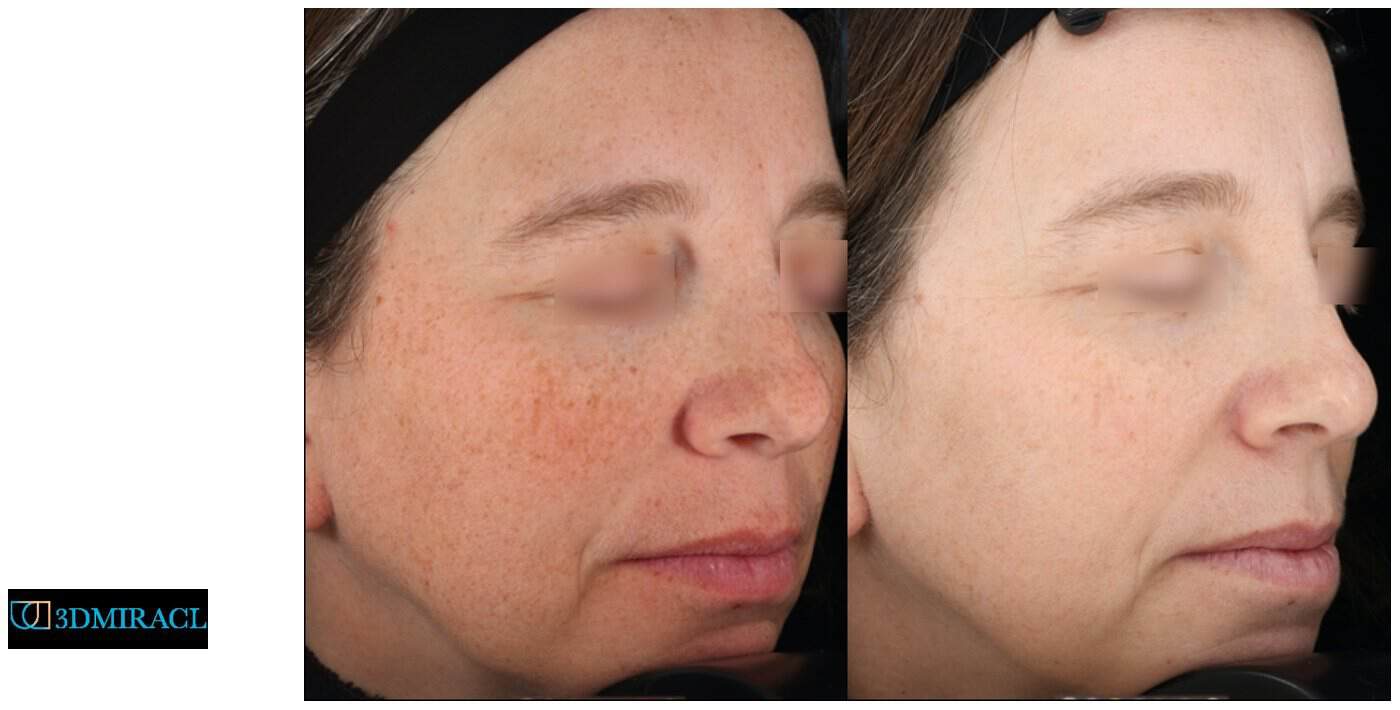 Before and after 3DMIRACL UltraClear treatment, sun damage and freckling across the cheeks and nose visibly lighter