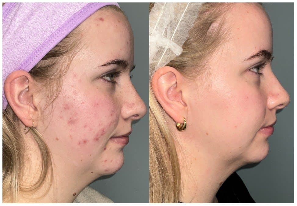 Before and after UltraClear treatment for acne scarring on the cheek and jaw, side view