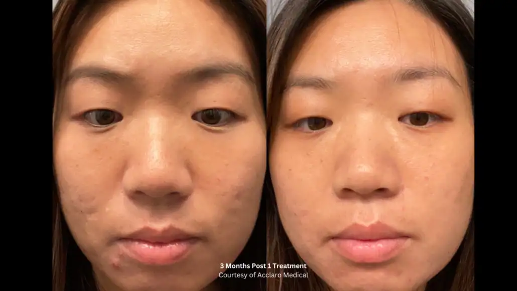 Before and after UltraClear treatment, three months after a single session, post-breakout marks and uneven tone cleared
