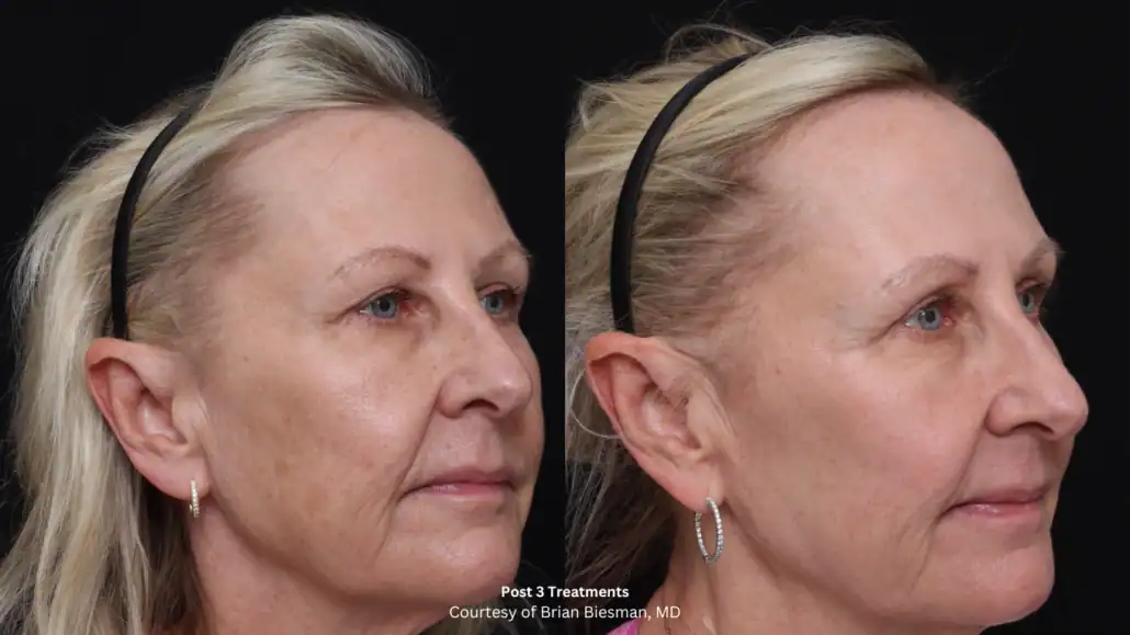 Before and after three UltraClear treatments on a woman in her fifties, profile view, lines and sun damage softened