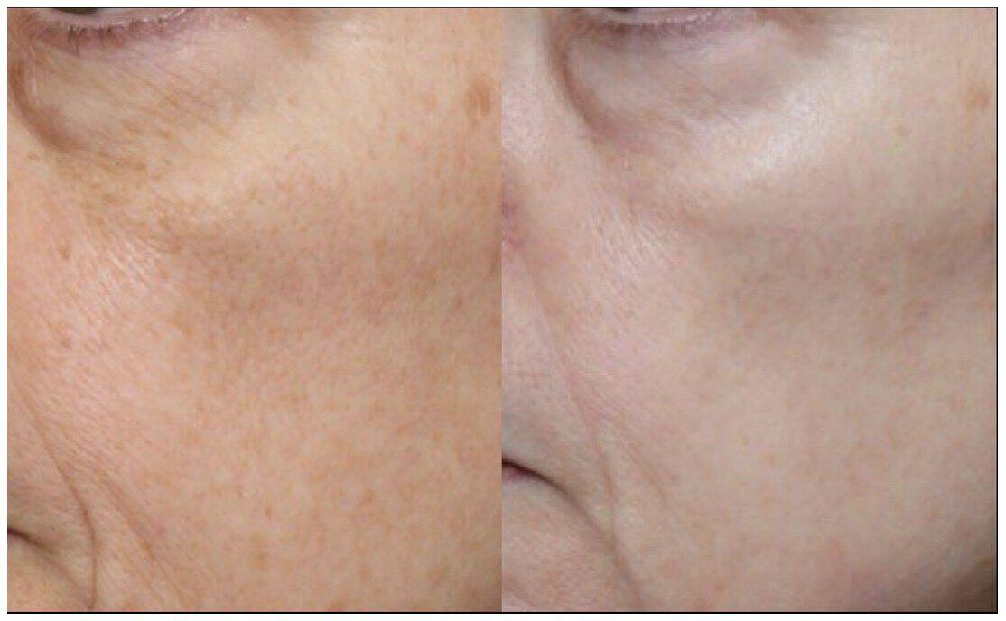Close-up before and after UltraClear treatment, rough cheek texture and visible pores refined