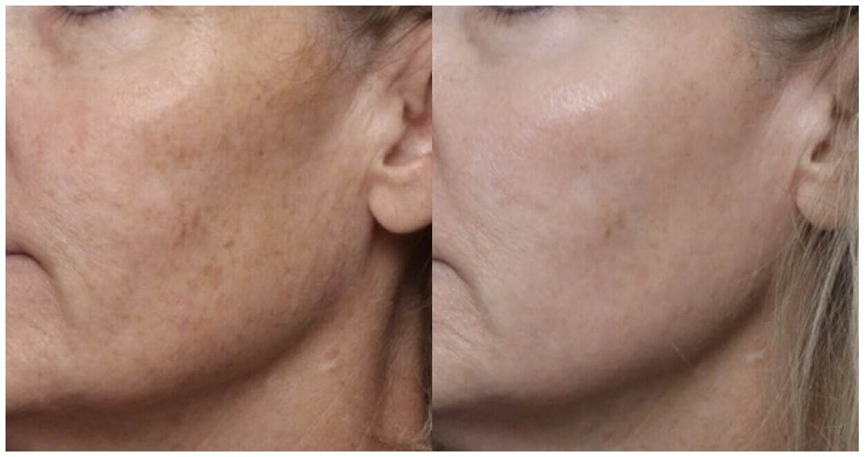 Before and after UltraClear Clear+ treatment, cheek texture and uneven tone smoothed