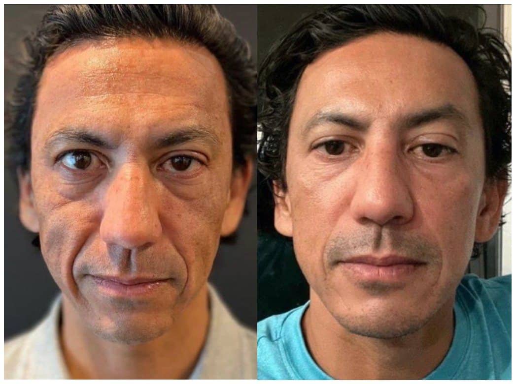 Before and after a customised UltraClear treatment on Fitzpatrick type V skin, tone more even and texture smoother