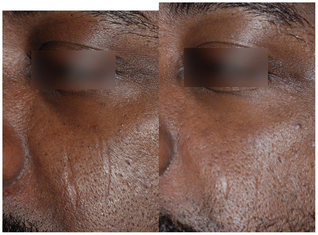 Before and after a customised UltraClear treatment on Fitzpatrick type VI skin, texture and tone improved with no dark marks