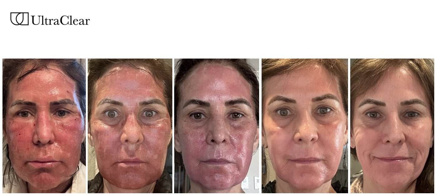 Five-stage healing progression after one full-face UltraClear resurfacing treatment, from deep redness on day one to settled skin