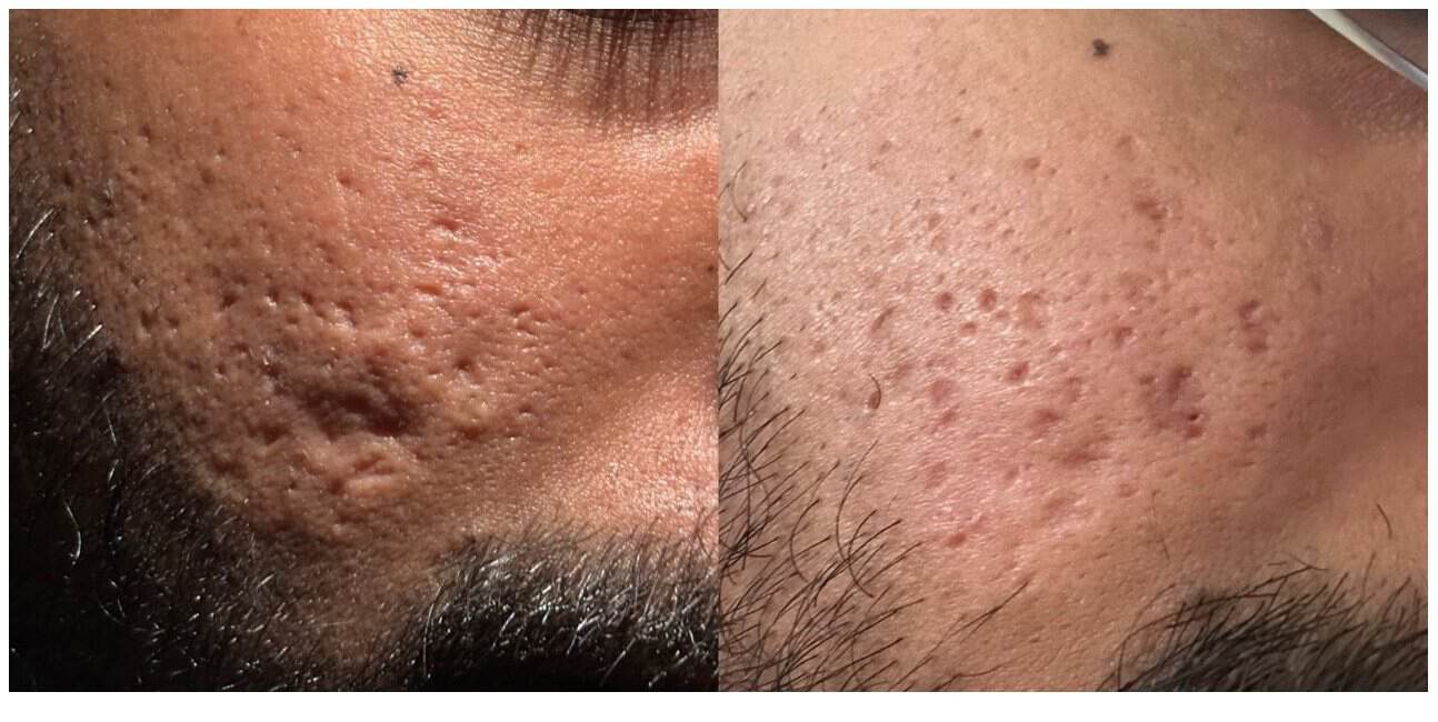 Close-up before and after UltraClear with Laser-Coring for pitted acne scarring on the cheek, scars shallower and skin more even