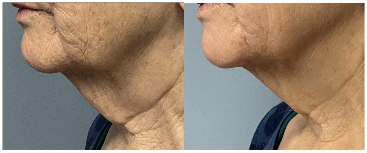 Before and after UltraClear Laser-Coring treatment, deep lines along the jawline and neck softened