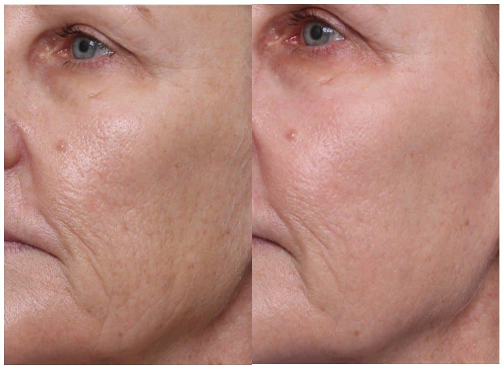 Before and after UltraClear mode resurfacing, fine lines and texture on the cheek smoothed