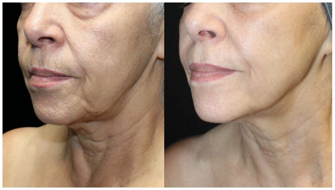 Before and after UltraClear mode resurfacing on mature skin, lines and sun damage softened across the cheek and jaw