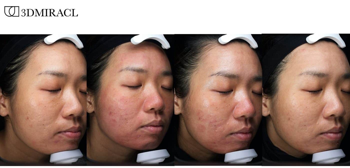 Four-stage healing progression after a combined 3DMIRACL and Ultra UltraClear treatment, from redness to settled skin