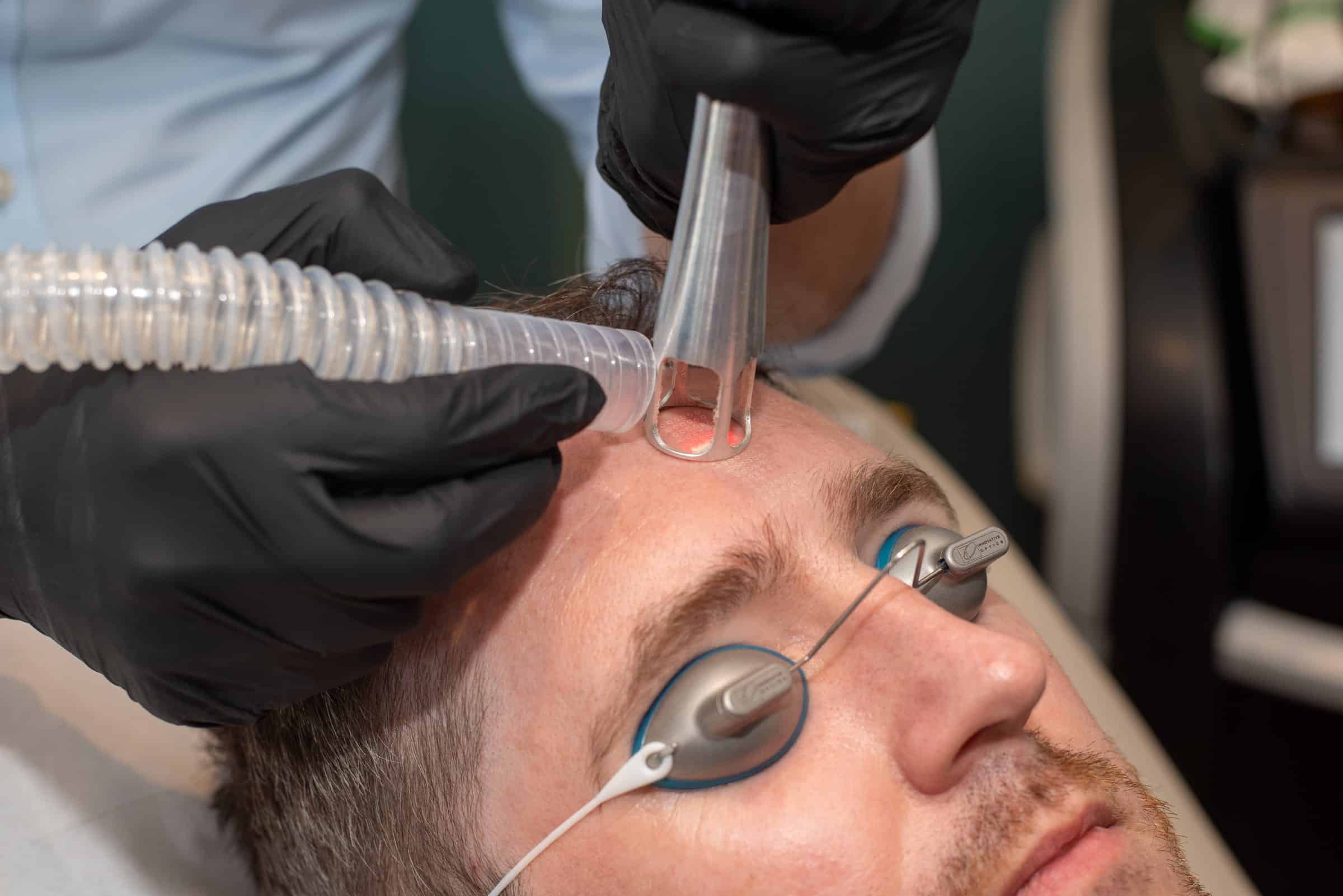 The UltraClear laser handpiece on a patient's forehead, with protective eye shields, at Cannelle Skin Clinic in Oxford
