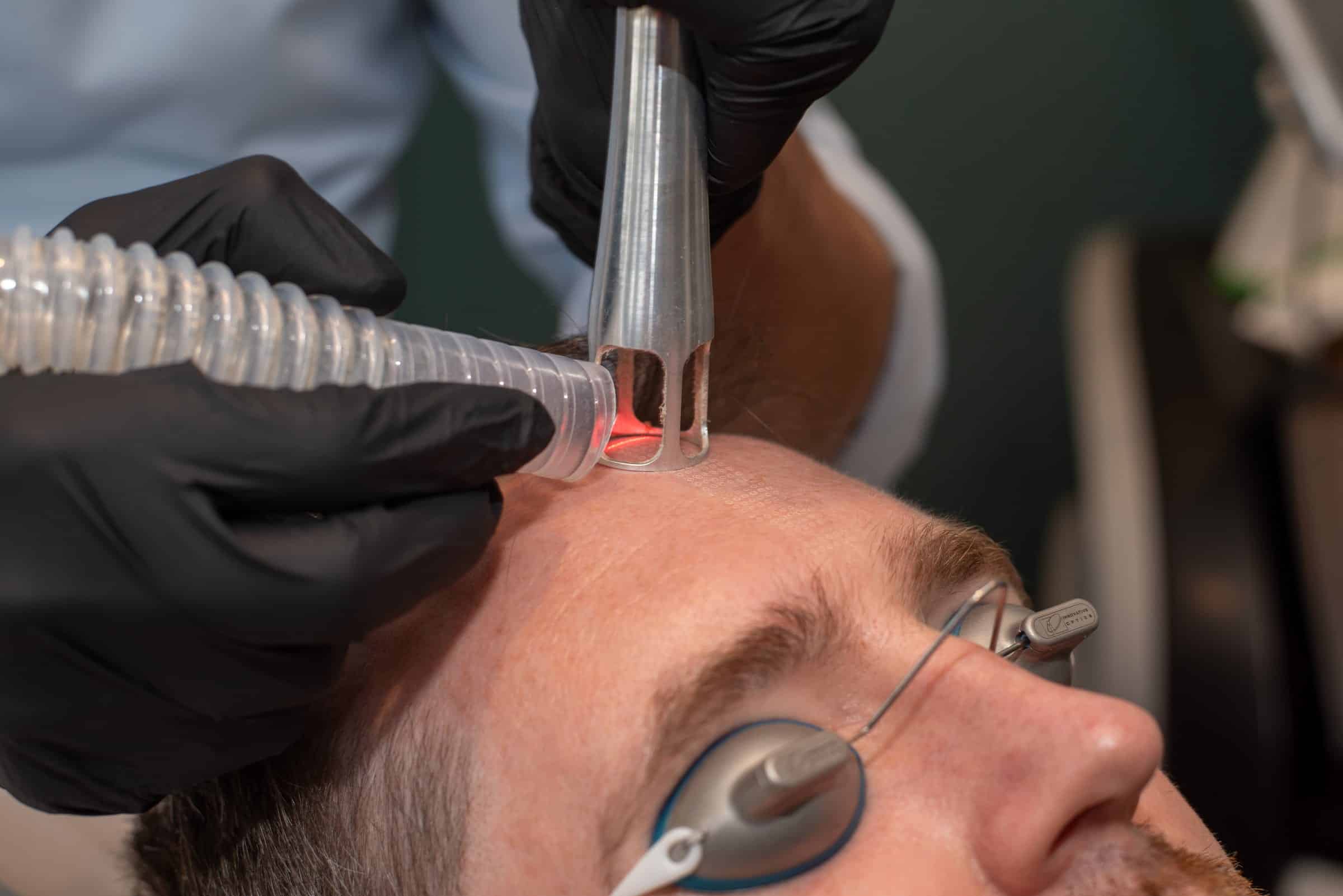 The UltraClear cold fibre laser treating the forehead during a session at Cannelle in Summertown