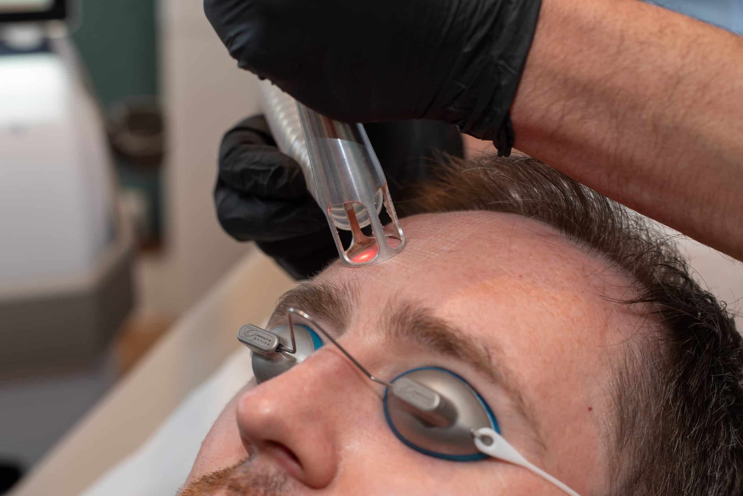 The UltraClear handpiece moving across the brow at Cannelle Skin Clinic in Oxford