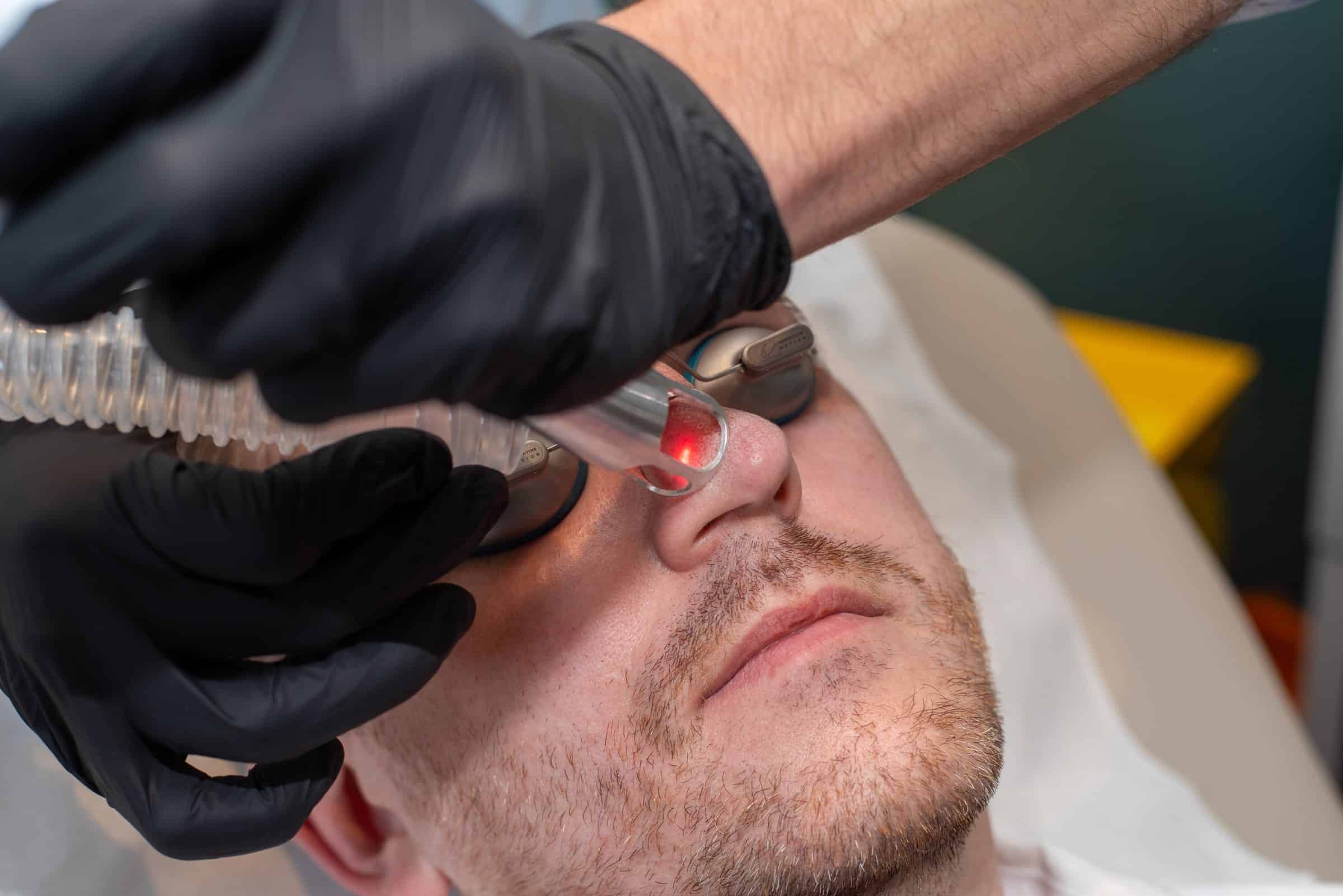 UltraClear laser treatment along the nose at Cannelle Skin Clinic in Summertown